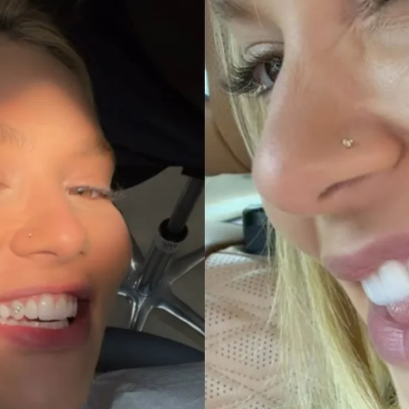 De acordo com a Coluna Veja Gente, o especialista Leonardo Acioli destaca que a aplicação de um tooth gem não deve ser encarada como um procedimento que termina no momento em que a joia é colocada, já que é necessário acompanhar como o dente e a gengiva respondem ao acessório