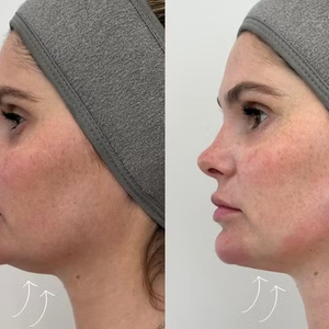 Nesta quinta-feira (26), a modelo usou os Stories do Instagram para mostrar aos seguidores a aplicação de faixas autoadesivas de sustentação, uma técnica que ajuda a reposicionar a pele e afinar o contorno facial.