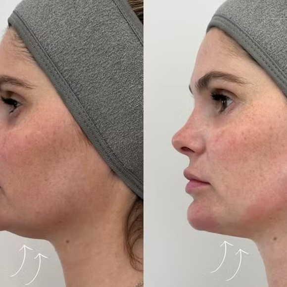 Nesta quinta-feira (26), a modelo usou os Stories do Instagram para mostrar aos seguidores a aplicação de faixas autoadesivas de sustentação, uma técnica que ajuda a reposicionar a pele e afinar o contorno facial.