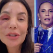 'Ela precisa se recuperar': após fratura no rosto e cirurgia recente, Ivete Sangalo é confirmada no 'BBB 26' e preocupa fãs