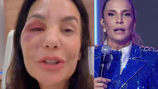 'Ela precisa se recuperar': após fratura no rosto e cirurgia recente, Ivete Sangalo é confirmada no 'BBB 26' e preocupa fãs