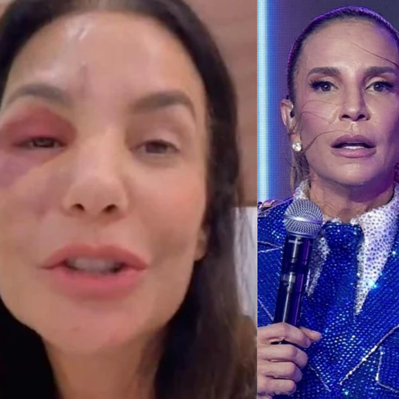 'Ela precisa se recuperar': após fratura no rosto e cirurgia recente, Ivete Sangalo é confirmada no Big Brother Brasil 26 e preocupa fãs