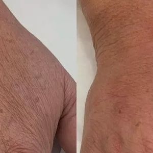 Na JK Estética Avançada, Nadine Gonçalves já havia feito harmonização nas mãos