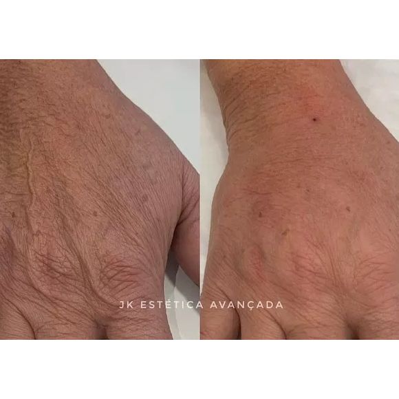 Na JK Estética Avançada, Nadine Gonçalves já havia feito harmonização nas mãos