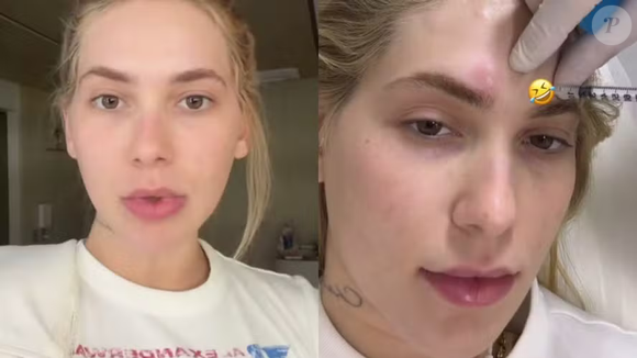 Virginia Fonseca revela piora nas crises de enxaqueca após 'espaçar' tratamento e faz alerta sobre dor incapacitante