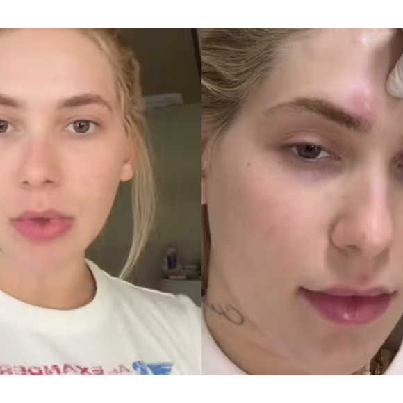 Virginia Fonseca revela piora nas crises de enxaqueca após 'espaçar' tratamento e faz alerta sobre dor incapacitante