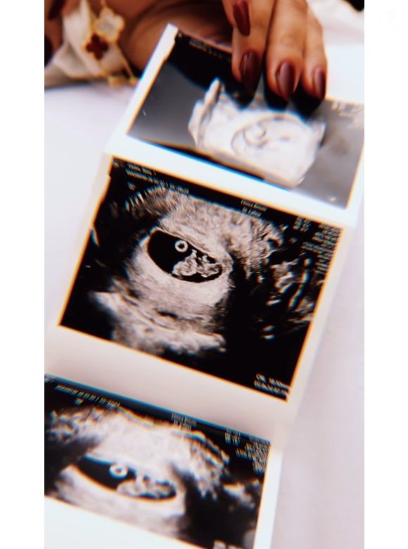 Tainá Militão, mãe de um casal, e Eder Militão, pai de uma menina, esperam primeiro bebê juntos
