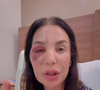Ivete Sangalo sofreu uma fratura no rosto após um desmaio dentro de casa