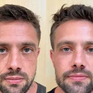 Em junho de 2024, Rafael Cardoso passou por uma harmonização facial que deixou o ator bem diferente