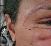 Juliana Soares levou vários pontos no rosto, que ficou desfigurado após o crime
