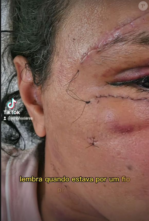 Juliana Soares levou vários pontos no rosto, que ficou desfigurado após o crime