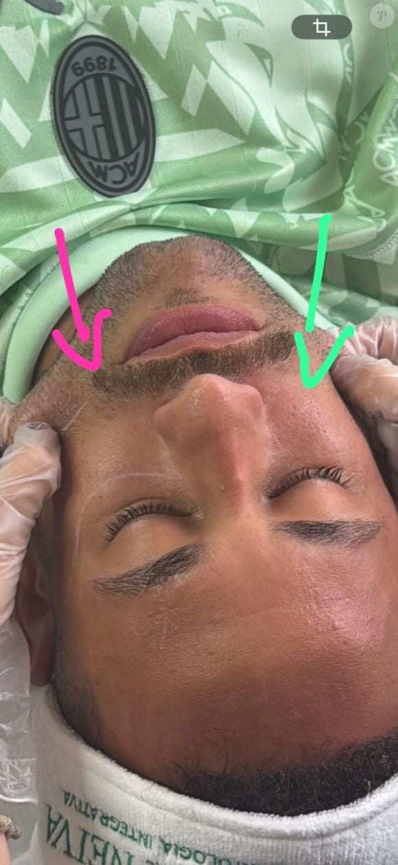 No caso de Neymar, o local escolhido foi o rosto, com uma diferença já visível após a realização do XERF, conforme mostra o resultado