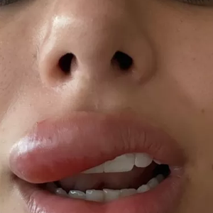 Bruna Biancardi teve celulite facial após espremer uma espinha na boca