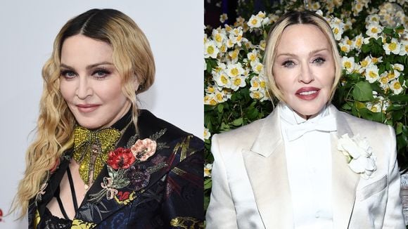 Madonna não esconde o uso do botox e hoje, aos 67 anos, tem a aplicação como um dos segredos de sua beleza