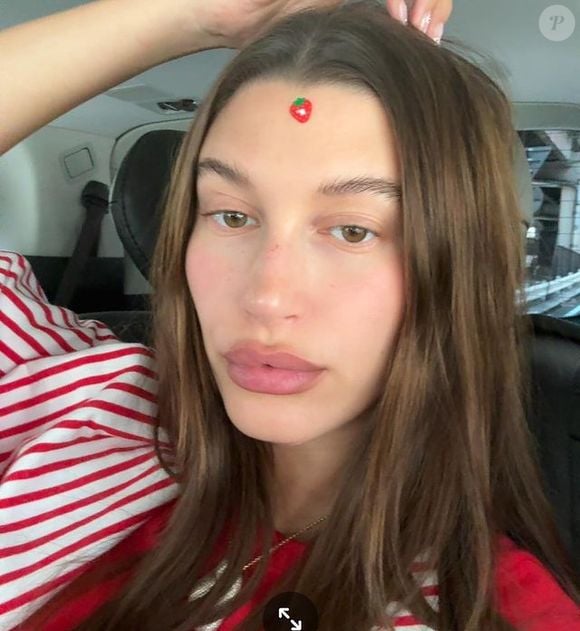 Hailey Bieber revelou, por meio das redes sociais, que sofre com dermatite perioral