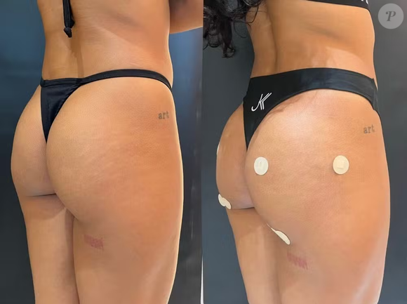 “Bella buscava apenas ajustes sutis no contorno corporal, especialmente na região do glúteo e da depressão trocantérica”, explicou a clínica