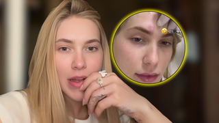 Aposente as dores intensas: o erro de Virgínia após 'espaçar' o tratamento de enxaqueca; entenda por que especialistas recomendam disciplina rigorosa para evitar o efeito rebote