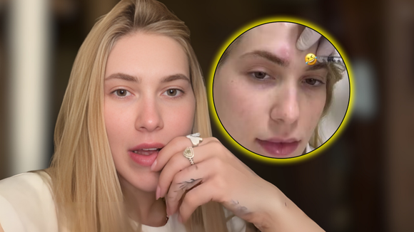 Aposente as dores intensas: o erro de Virgínia após 'espaçar' o tratamento de enxaqueca; entenda por que especialistas recomendam disciplina rigorosa para evitar o efeito rebote