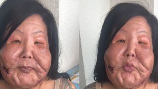 Antes e depois: Juju do Pix passa por nova cirurgia após remover óleo mineral do rosto, mas resultado divide opiniões. 'Não pareceu gostar'