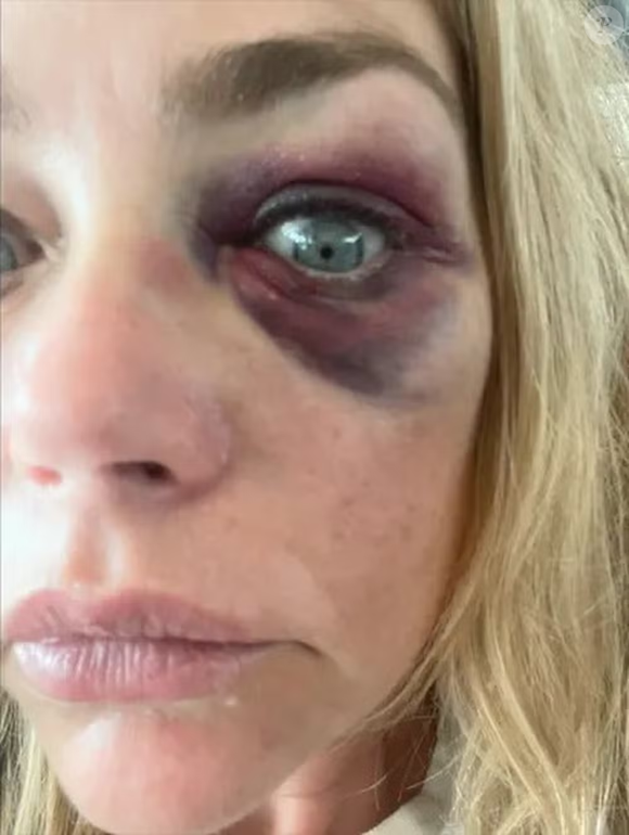 Denise Richards choca ao revelar hematoma no olho após ser agredida