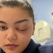 Começou como uma 'gripezinha': olho de adolescente salta 'como uma bola de golfe' e ela descobre infecção bacteriana espalhada no cérebro