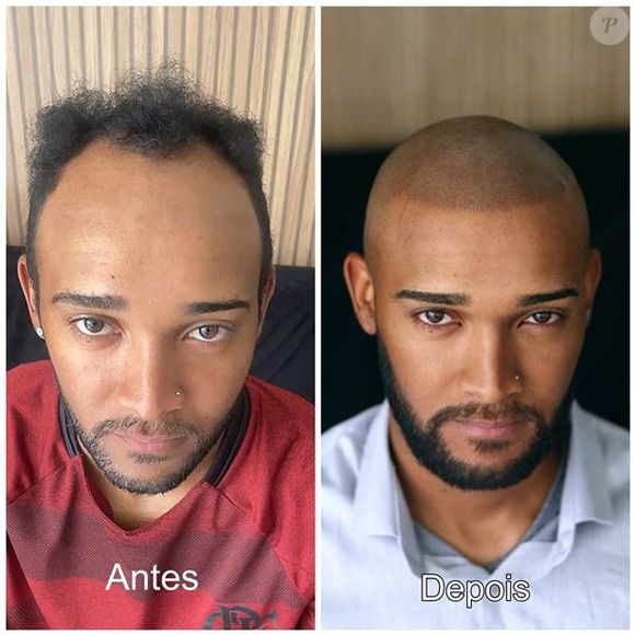 A micropigmentação capilar é a aplicação superficial de pigmentos no couro cabeludo para criar um efeito visual de maior densidade capilar