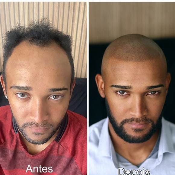 A micropigmentação capilar é a aplicação superficial de pigmentos no couro cabeludo para criar um efeito visual de maior densidade capilar
