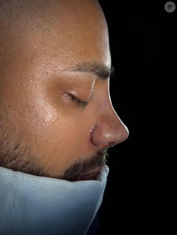 Veja foto do 'depois' do sósia de Neymar após rinoplastia