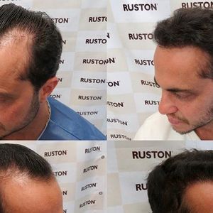 Thammy Miranda já passou por transplante capilar: veja antes e depois