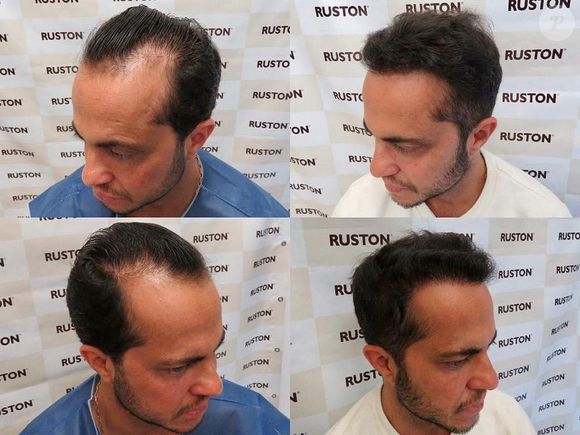 Thammy Miranda já passou por transplante capilar: veja antes e depois