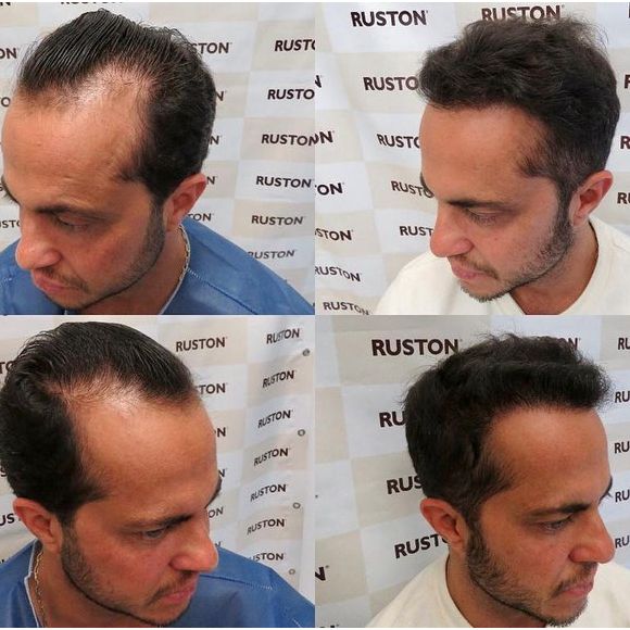 Thammy Miranda já passou por transplante capilar: veja antes e depois