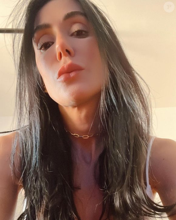 Michelle Barros fez preenchimentos em diversas áreas do rosto na tentativa de harmonizá-lo