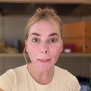 Deu ruim? Virgínia se arrepende após novo procedimento estético antes das festas de fim de ano e agita a web: 'Rosto pipocado'