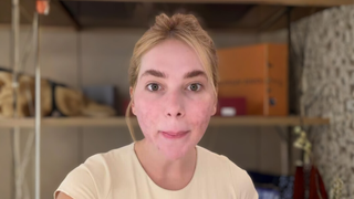 Deu ruim? Virgínia se arrepende após novo procedimento estético antes das festas de fim de ano e agita a web: 'Rosto pipocado'