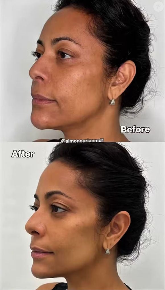 Samantha Schmütz já havia realizado procedimentos com o Dr. Simon Ourian, que assina as transformações da família Kardashian