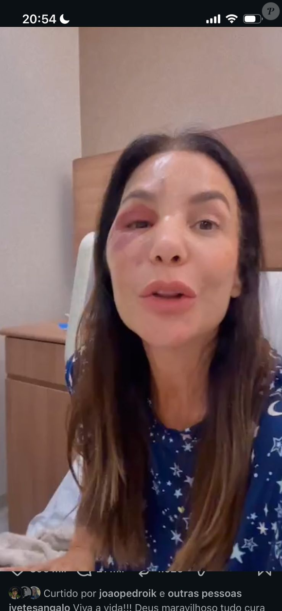 Ivete Sangalo aparece com edemas no rosto durante live após passar por cirurgia facial no Hospital Sírio-Libanês