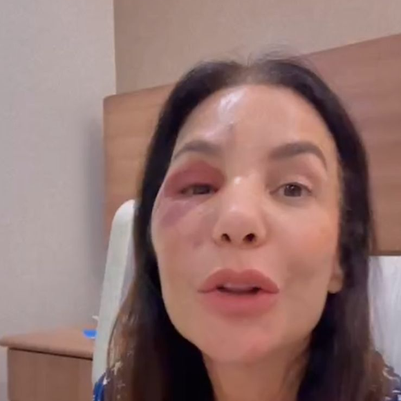 Ivete Sangalo aparece com edemas no rosto durante live após passar por cirurgia facial no Hospital Sírio-Libanês