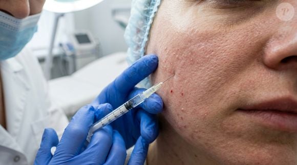 O PDRN também ganhou fama pelo potencial bioestimulador, especialmente por sua possível relação com os fibroblastos, células responsáveis pela produção de boa parte do colágeno da pele. A proposta, porém, não é preencher uma ruga como um procedimento convencional, mas melhorar as condições para que a própria pele funcione melhor