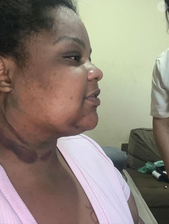 Funkeira celebra nova fase ao exibir antes e depois de procedimento estético