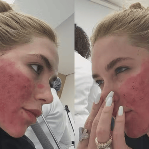 Virgínia Fonseca chama atenção ao surgir com o rosto em 'carne viva' após procedimento estético e tranquiliza seguidores sobre o pós-tratamento