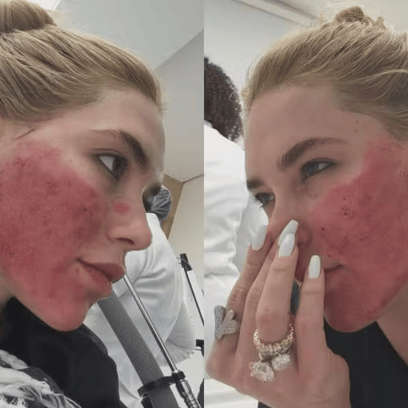 Virgínia Fonseca chama atenção ao surgir com o rosto em 'carne viva' após procedimento estético e tranquiliza seguidores sobre o pós-tratamento