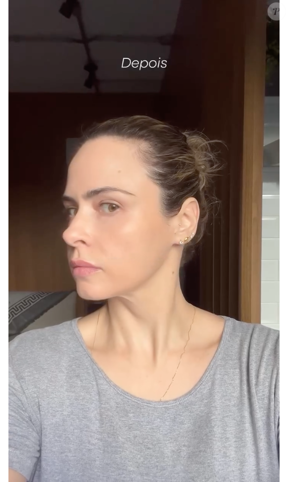 Antes e depois da pele de Ana Paula Renault é impressionante. Belíssima no 'BBB 26', ela é a prova de que a estética impulsiona a beleza, quando bem feita