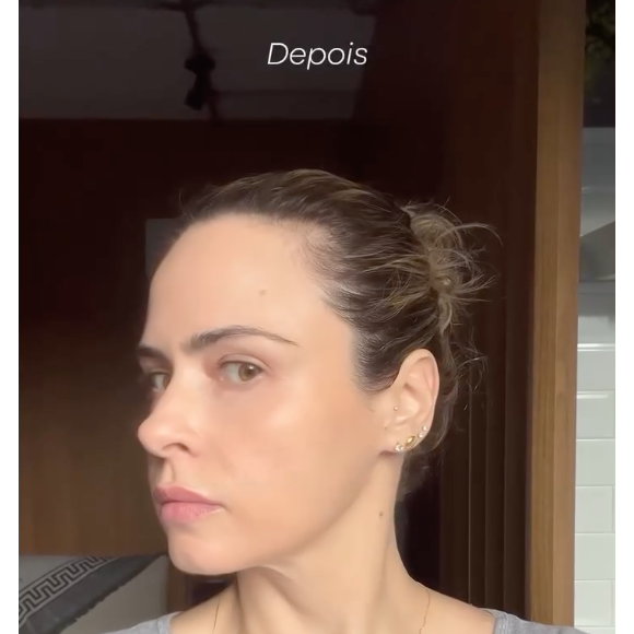 Antes e depois da pele de Ana Paula Renault é impressionante. Belíssima no 'BBB 26', ela é a prova de que a estética impulsiona a beleza, quando bem feita