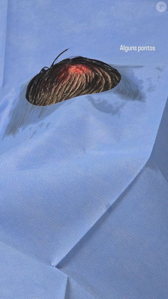 Kayky Brito precisou levar pontos após queda de bicicleta