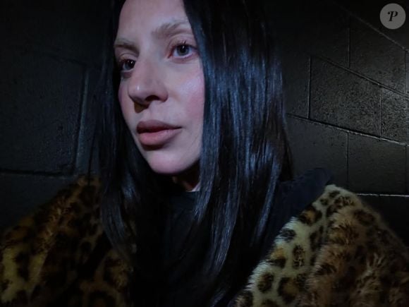 Doença de Lady Gaga: a SBR define a fibromialgia como uma síndrome clínica que se manifesta com dor no corpo todo, principalmente na musculatura