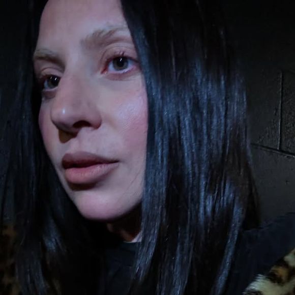 Doença de Lady Gaga: a SBR define a fibromialgia como uma síndrome clínica que se manifesta com dor no corpo todo, principalmente na musculatura