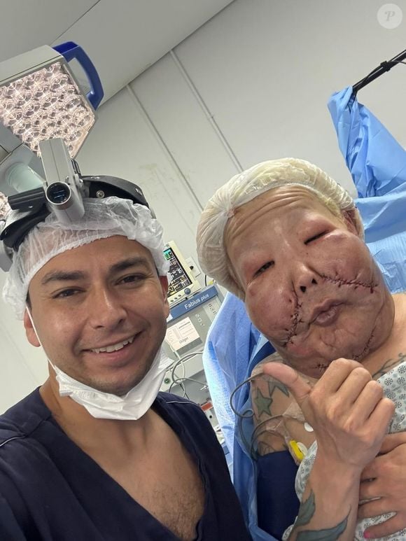 Segundo o médico, o óleo mineral no rosto de Juju do Pix já estava endurecido, o que dificultou a cirurgia