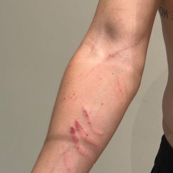 Danilo Bravo publicou uma foto do seu braço arranhado após a confusão