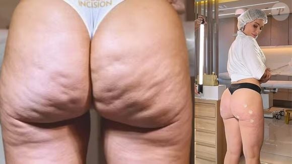 Giselle Prattes apostou em bioestimuladores de colágeno para tratar as celulites e flacidez do bumbum