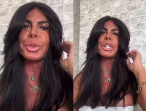 Gretchen passou recentemente por um novo procedimentos estéticos mas, desta vez, para retirar preenchedores